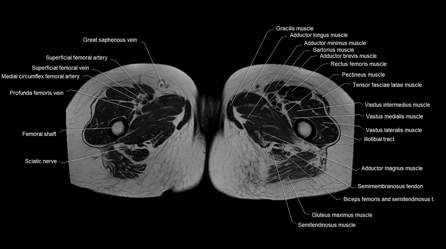 MRI 3T pelvis axial cross section anatomy image 37.webp